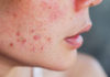 Tips-to-Getting-Rid-of-the-Issue-like-Hormonal-Acne-on-newstime
